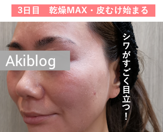 ゼオスキン皮むけいつから 使い方と使用から7日目までの経過 現役美容カウンセラーakiの美容ブログ