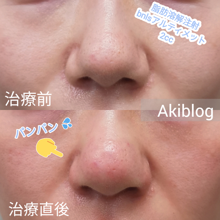 Bnlsアルティメットは効果なし 効果はいつから Bnlsアルティメット鼻の痛みや腫れ ダウンタイムや効果など経過を画像で解説 現役美容カウンセラーakiの美容ブログ