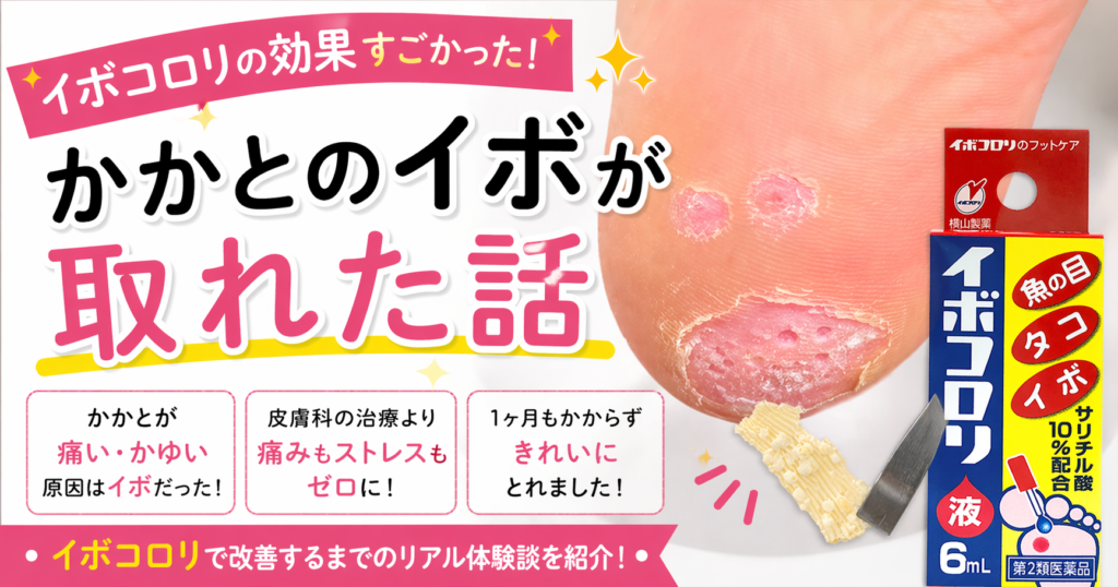 かかとが痛い・かゆい原因は？イボだった体験談とイボコロリの効果