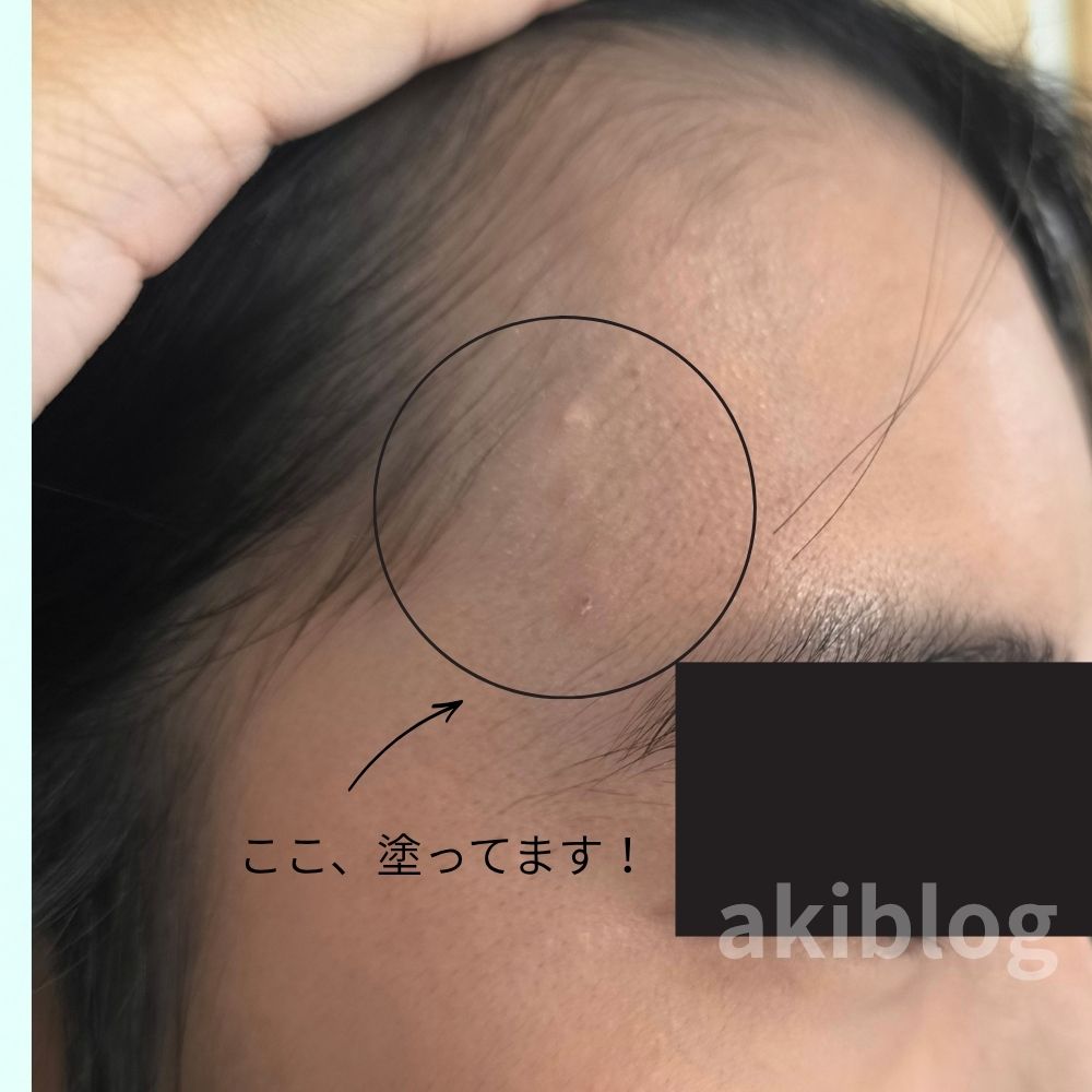 アクセーヌ ニキビコンシーラー使用後