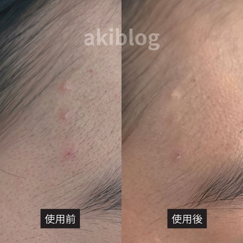 アクセーヌ ニキビコンシーラー使用前と使用後の比較