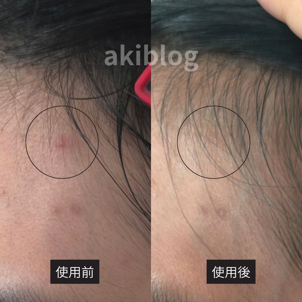 アクセーヌ ニキビコンシーラーで赤みをカバーした使用前後