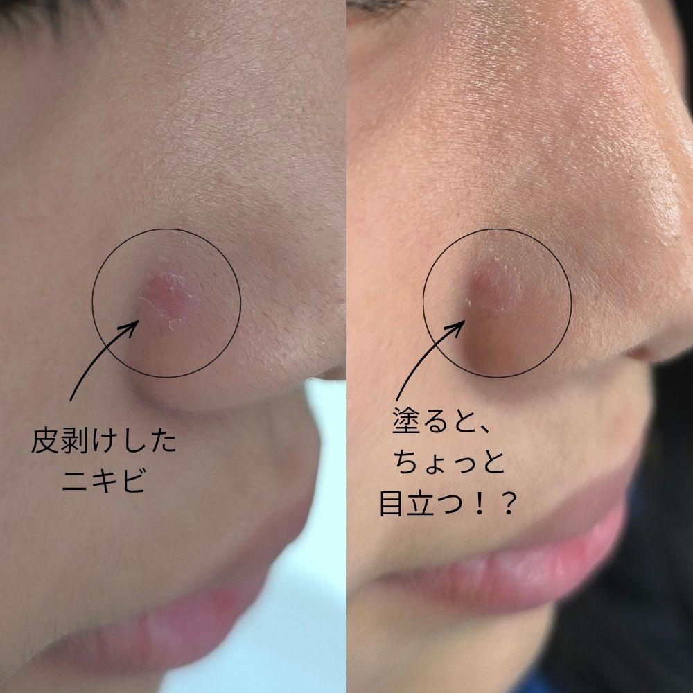 皮むけしたニキビにアクセーヌ ニキビコンシーラーを使用した比較